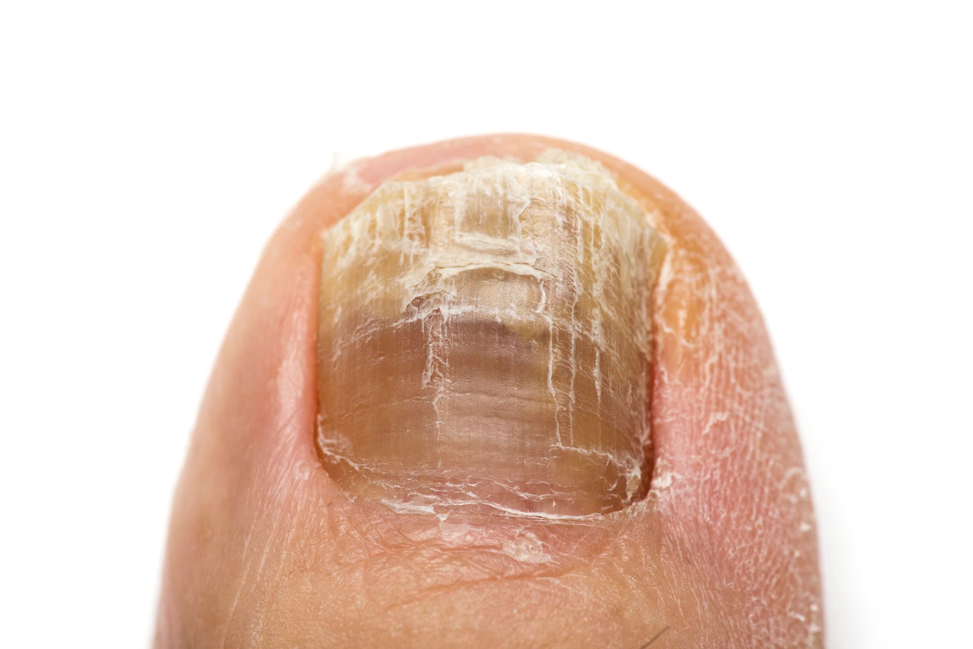 Mycose de l'ongle du pied : ongle épaissi, jauni et friable (onychomycose)