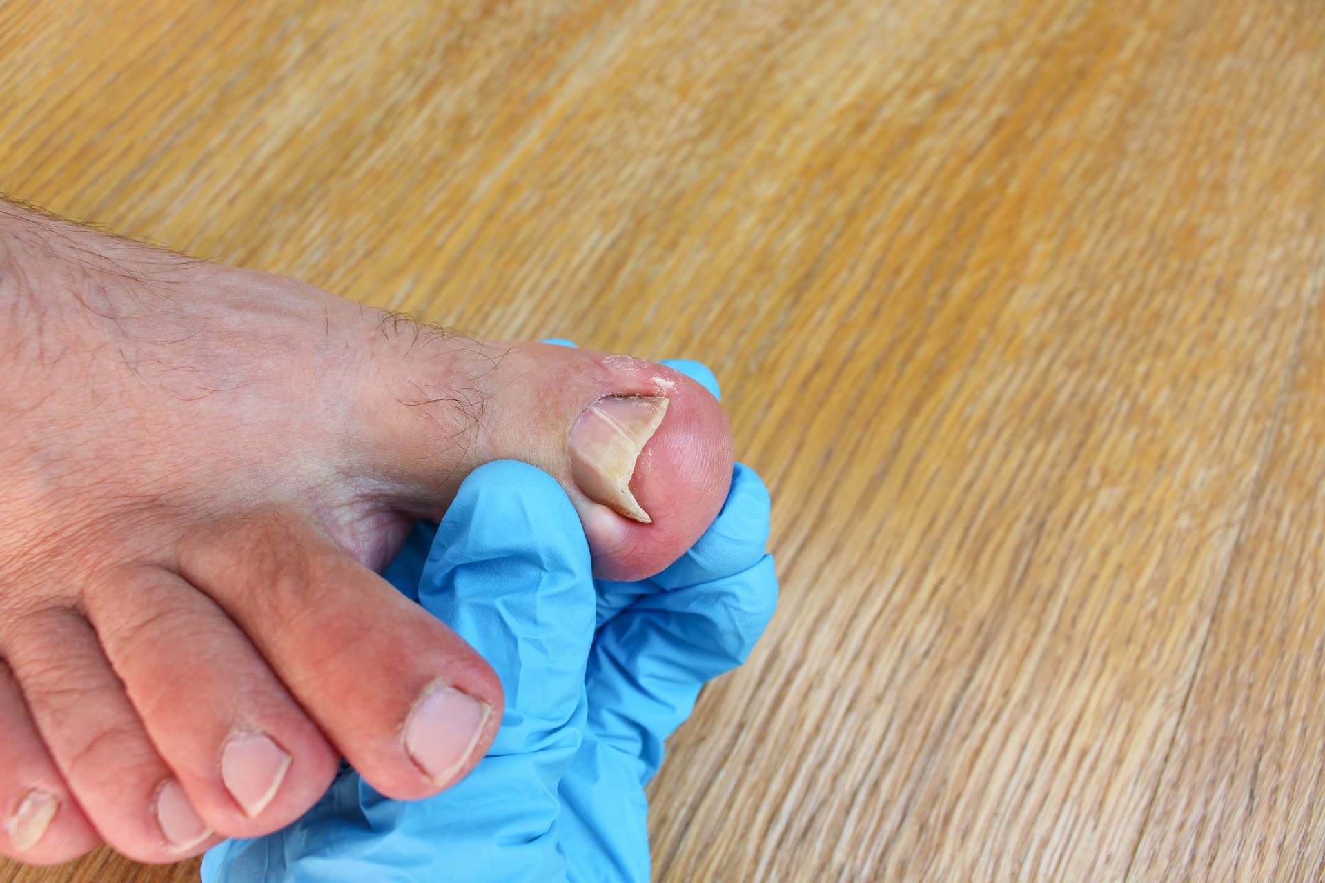 Ongle incarné du gros orteil examiné par un pédicure-podologue ganté